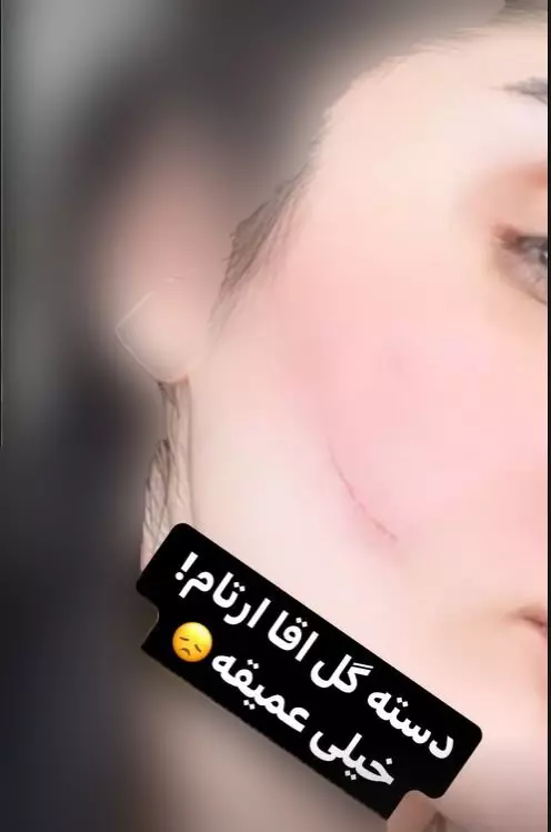 دنیا جهانبخت عکسی از صورت زخمی خود که ناشی از زخم عمیق پسرش آرتام بود را به اشتراک گذاشت.