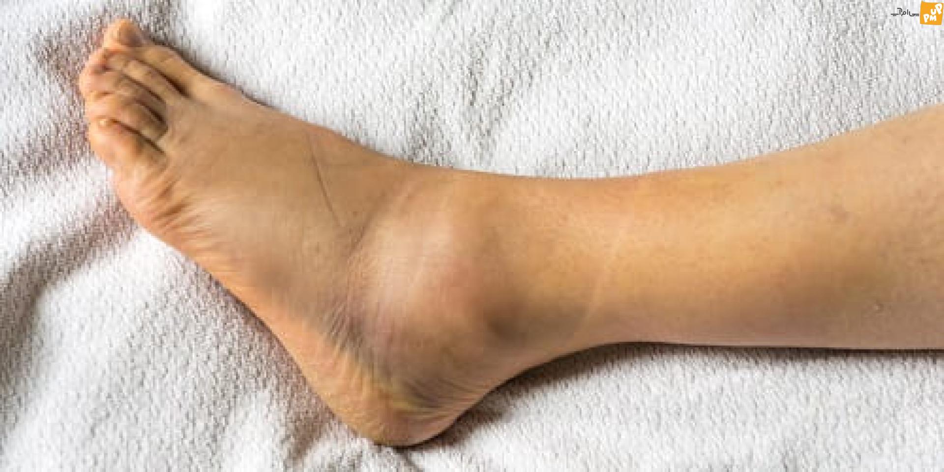 درد و تورم پاها نشانه چیست؟