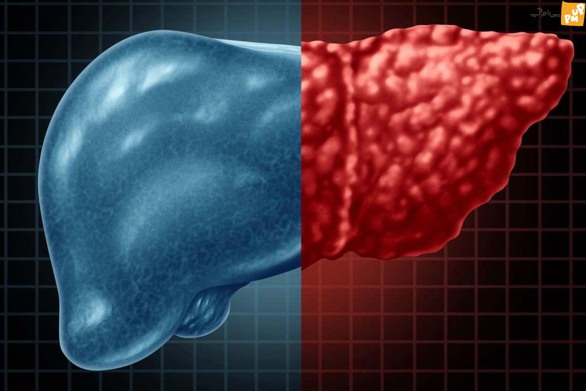راهکارهای درمانی برای کنترل کبد چرب غیر الکلی! / بررسی علائم و روش های درمان خانگی!
