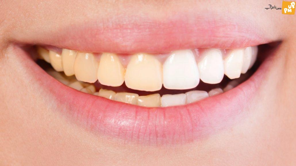 این ۵ عادت بد غذایی و سلامت، دندان‌های شما را زرد میکند! | جزئیات