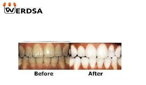 بررسی و انتخاب لمینت دندان متحرک Snap-on-Smile