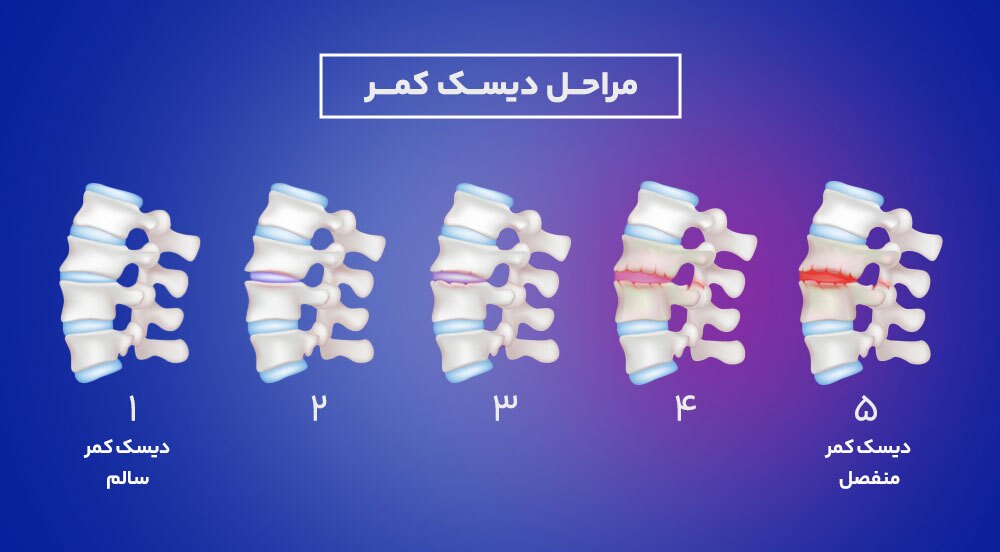 درمان دیسک کمر + معرفی بهترین روغن برای دیسک کمر