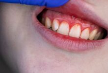 چه بیماری هایی باعث عفونت دندان و لثه می شوند؟