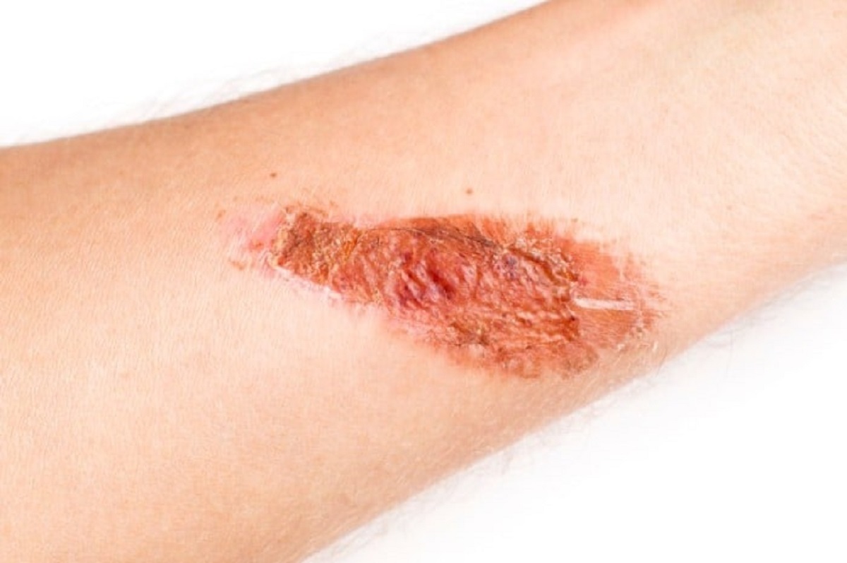 چگونه با طب سنتی سوختگی پوست را درمان کنیم؟