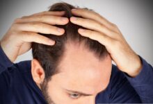 4 عامل اصلی ریزش مو را بشناسید