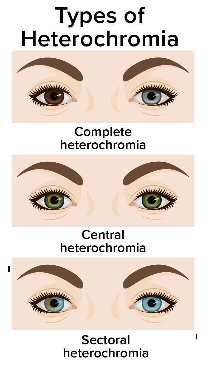 هتروکرومیا؛ زیبایی یک اختلال چشم