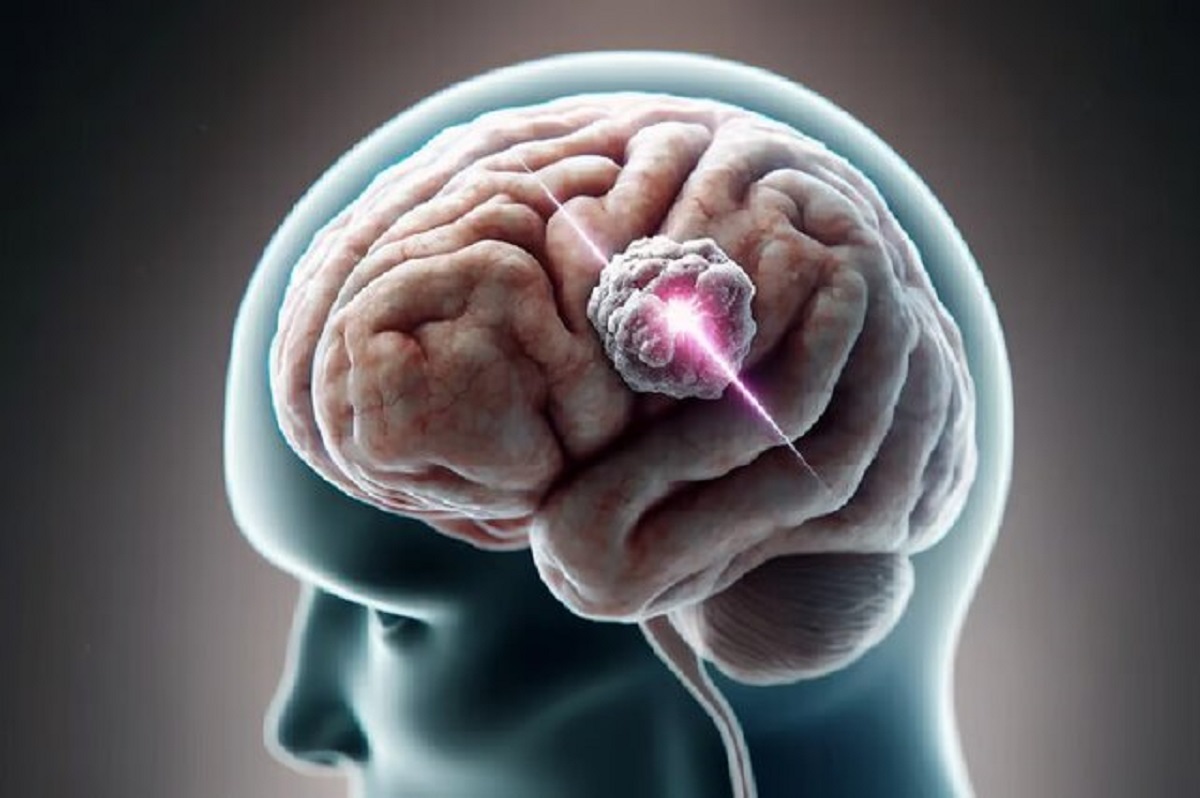 روشن کردن سلول‌های تومور مغزی با پرتو ایکس و نابودی هدفمند آنها