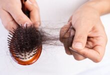 مهمترین عوامل ریزش مو در زنان