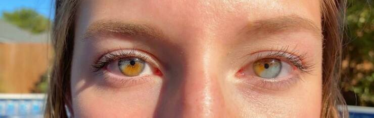 هتروکرومیا؛ زیبایی یک اختلال چشم(+تصاویر)