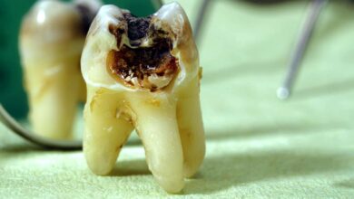 5 عادتی که دندان های شما را خراب می کند