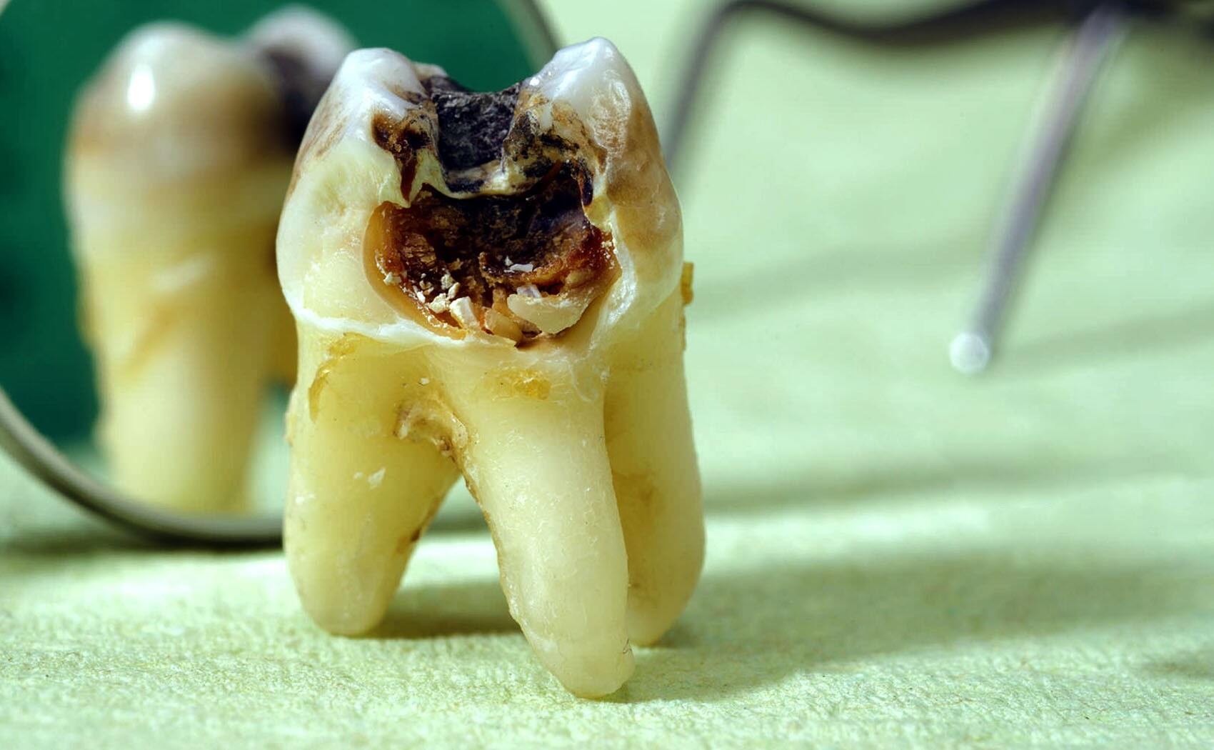 5 عادتی که دندان های شما را خراب می کند