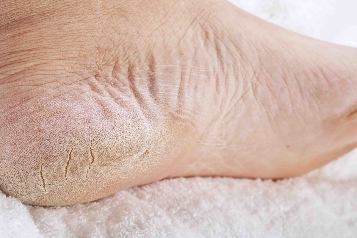کشف ارتباط خشکی پوست کف پا با نارسایی کبد