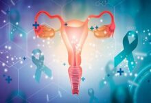 خطر سرطان تخمدان در زنان مبتلا به اندومتریوز چهار برابر بیشتر است
