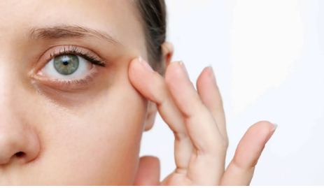 سیاهی دور چشم چه نوع کمبود ویتامینی است؟