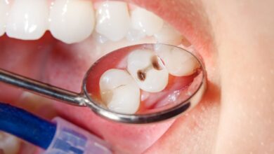 پوسیدگی دندان از علائم این بیماری است