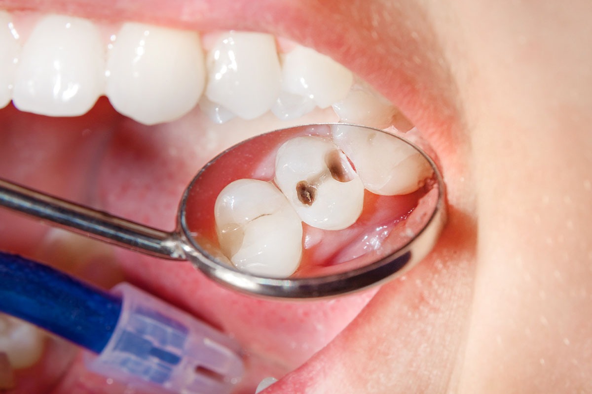 پوسیدگی دندان از علائم این بیماری است
