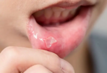 چرا آفت دهان ایجاد می شود و چگونه درمان می شود؟