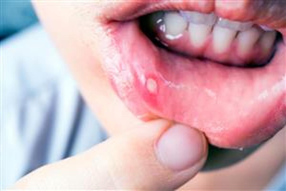 چرا دچار دهان درد می شویم و چگونه آن را درمان کنیم؟