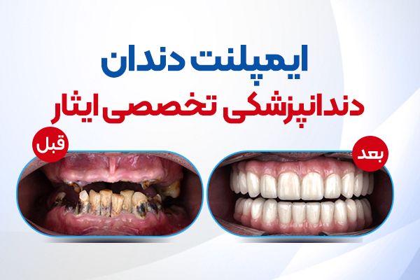 کاشت و ارتودنسی و ترکیب دندانپزشکی