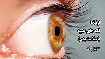 ارتباط لکه های عنبیه با سلامت بدن / هیچ لکه‌ای را نادیده نگیرید (فیلم)