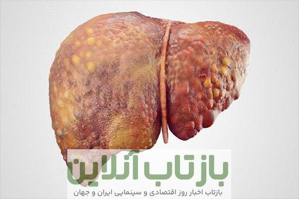 پیش بینی بیماری کبد چرب