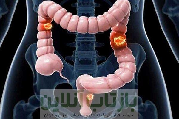 کاهش مرگ و میر با برنامه غربالگری سرطان روده بزرگ