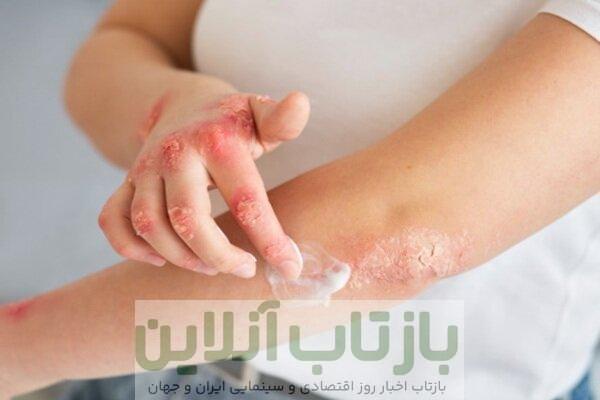 اگزما از کجا می‌آید و چطور می‌شود مهارش کرد؟