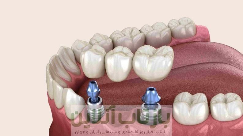 چه کسانی نمی توانند ایمپلنت کنند ؟