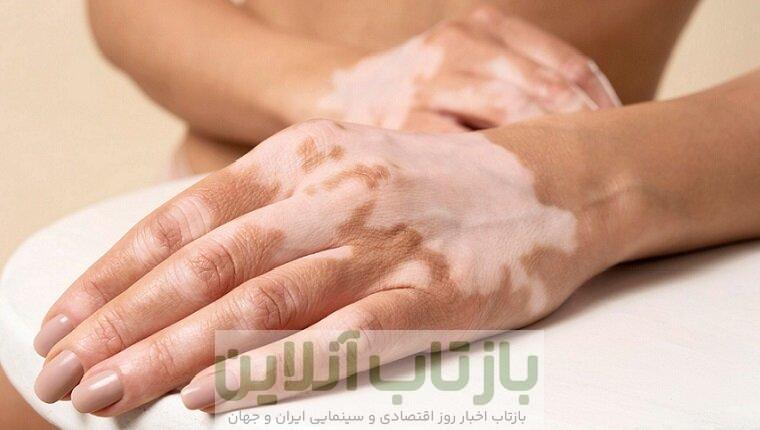 تازه‌ترین توصیه‌های پزشکی برای کنترل لک‌های پوستی