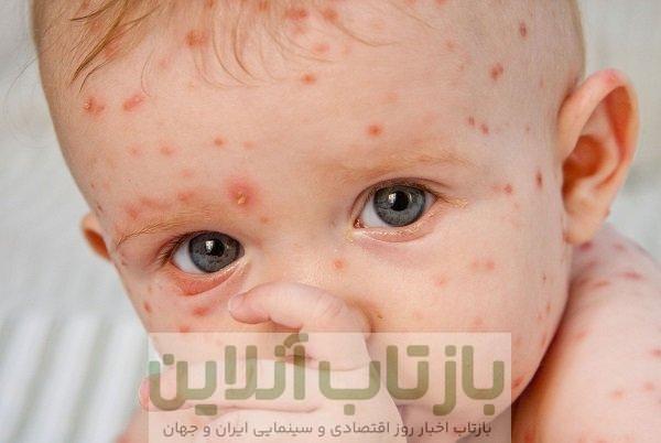 آبله‌مرغان در بزرگسالان؛ بیماری شدیدتر با عوارض خطرناک‌تر