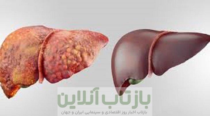کبد چرب زیر ذره‌بین ۲۰ سال پژوهش علمی در ایران