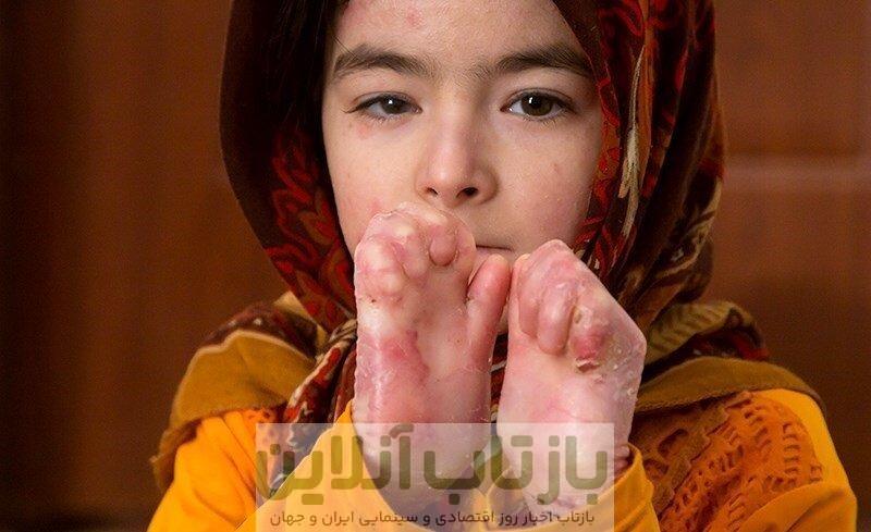 تجدید فراخوان تامین پانسمان‌های بیماران پروانه ای