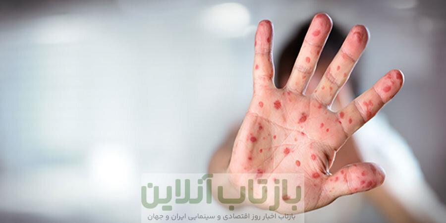 زنگ خطر «سرخک» در شمال کشور