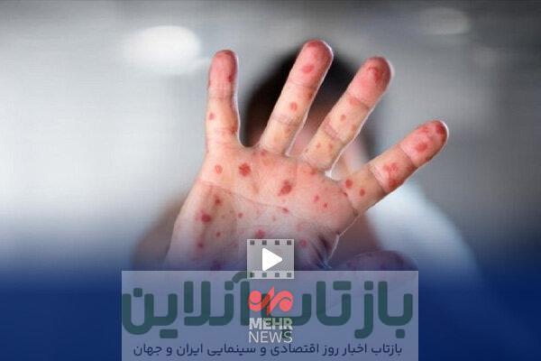 حذف سرخک و سرخجه در ایران؛ افتخاری در سایه همسایگی با کانون‌های بیماری