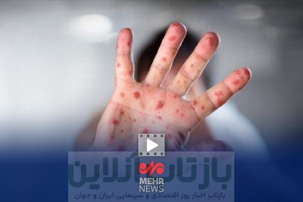 حذف سرخک و سرخجه در ایران؛ افتخاری در سایه همسایگی با کانون‌های بیماری