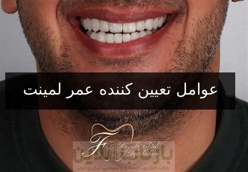 عمر لمینت دندان : لمینت دندان چقدر عمر می‌کند؟