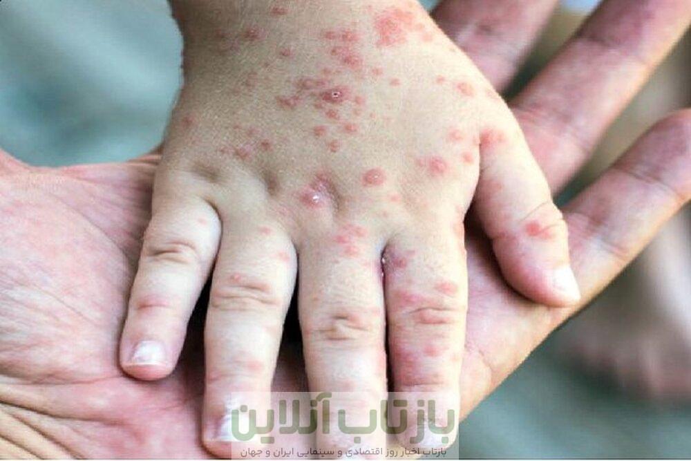 مرگ یک نوزاد در کانادا بر اثر سرخک در بحبوحه شیوع سراسری