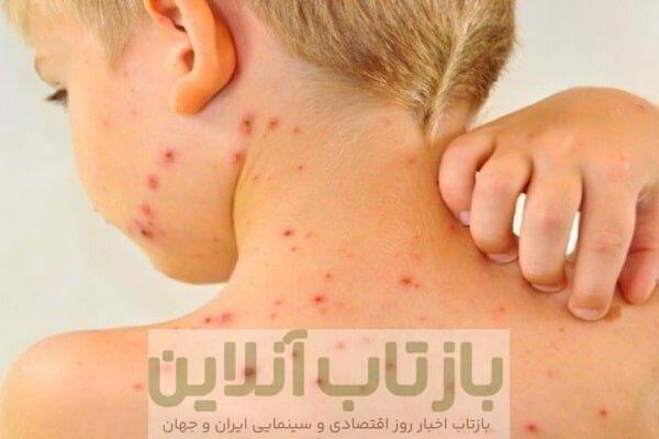 صدور هشدار سرخک برای شمال سیدنی