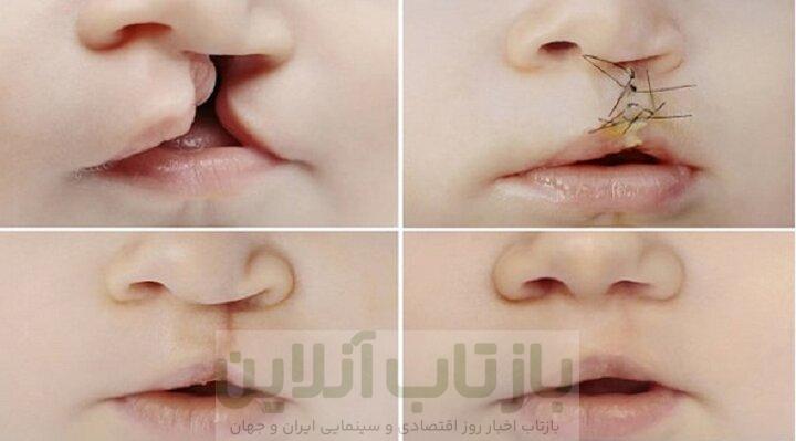 ۶ هزار عمل شکاف کام و لب در اصفهان انجام شد؛۵۰۰کودک در صف انتظار