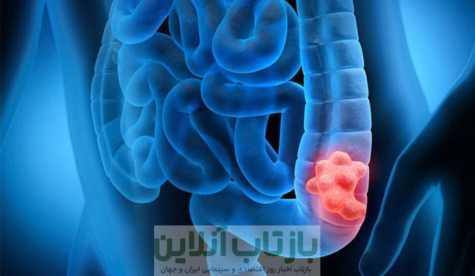 تدین: سن ابتلا به سرطان روده بزرگ در ایران کاهش نگران‌کننده دارد