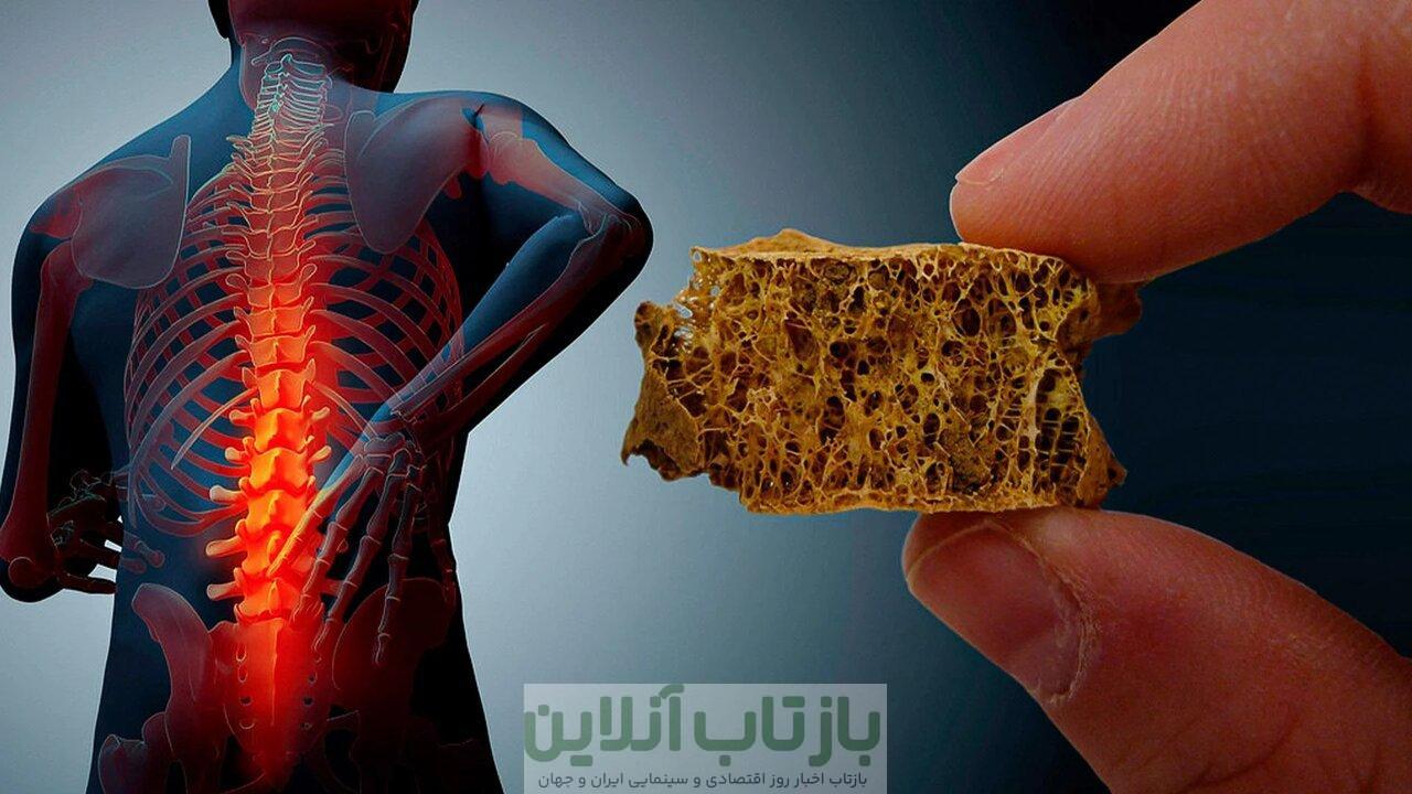 نیمی از زنان بالای ۵۰ سال کشور دچار پوکی استخوان هستند