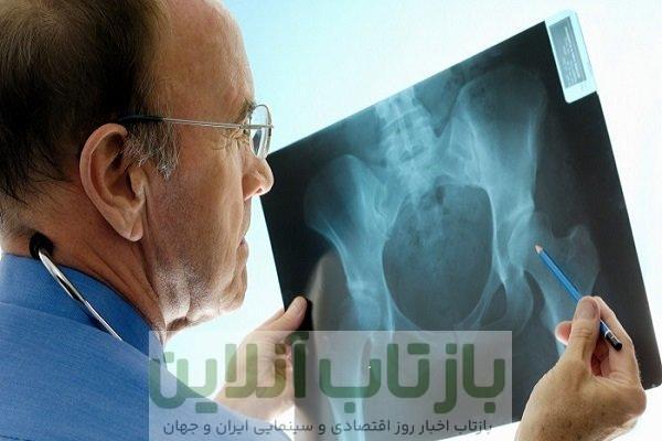 راه‌اندازی کلینیک‌های مدیریت شکستگی برای پیشگیری از پوکی استخوان