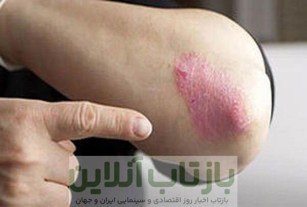 از بیماری «پسوریازیس» چه می دانید