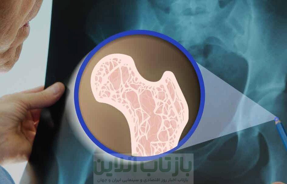 اجرای برنامه ملی کنترل پوکی استخوان در ۵ دانشگاه علوم پزشکی کشور 1 اجرای برنامه ملی کنترل پوکی استخوان در ۵ دانشگاه علوم پزشکی کشور