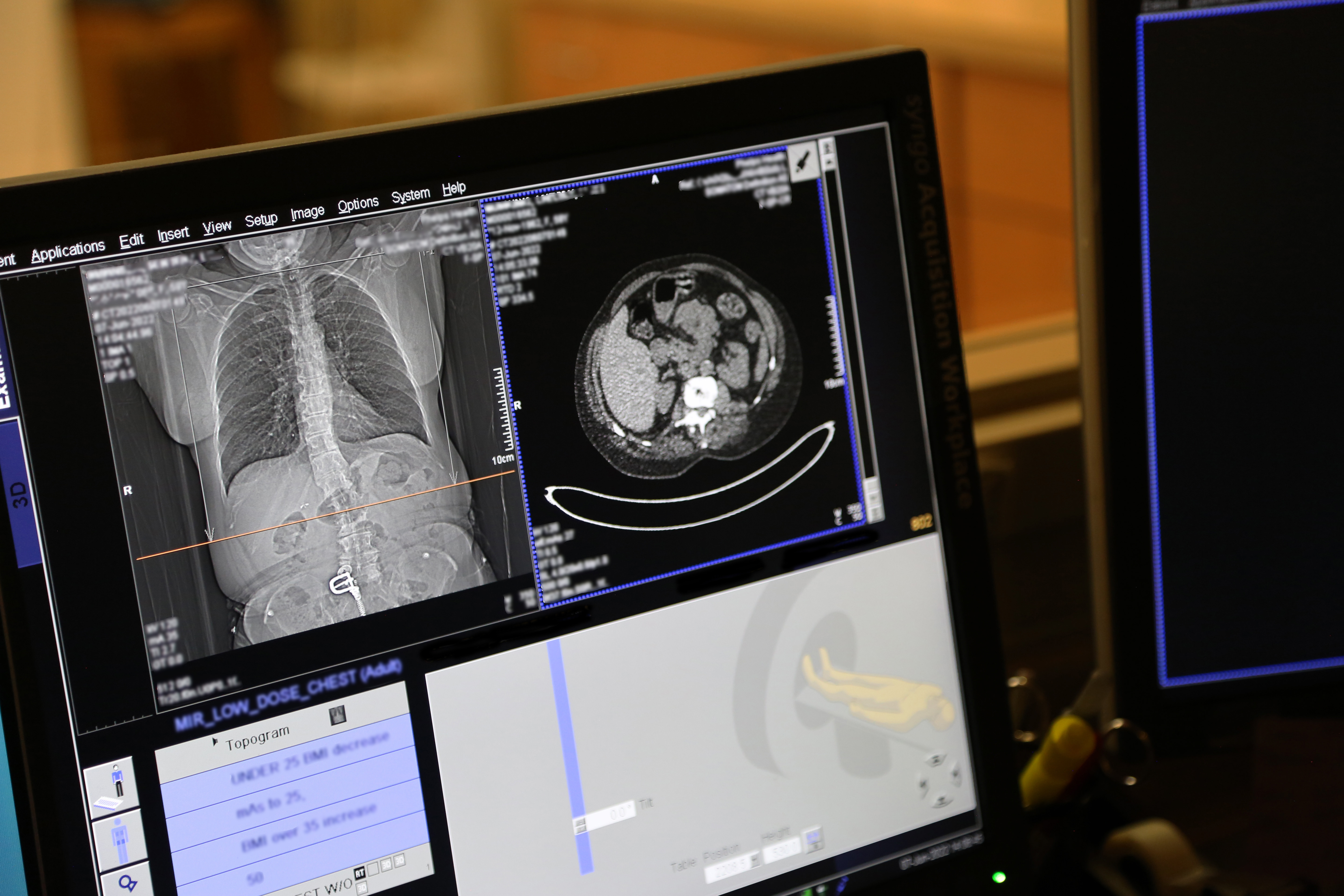 آنچه باید در مورد غربالگری سرطان ریه بدانید | فلپس سلامت
