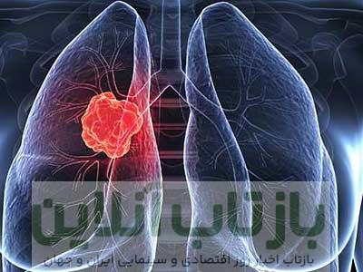 سرطان ریه و علائم به همراه درمان سرطان ریه - آروین کلینیک
