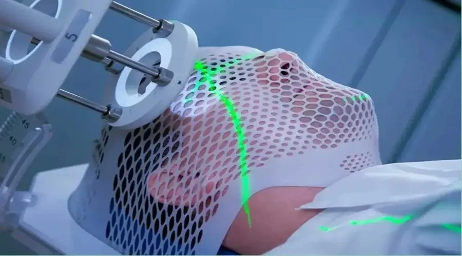 رادیوتراپی سرطان لب و زبان: آنچه که باید درمورد آن‌ها بدانید! - دکتر حسین  یحیی زاده