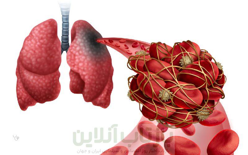آمبولی ریه چیست و چه خطراتی دارد؟ – مجله سلامت دکترتو