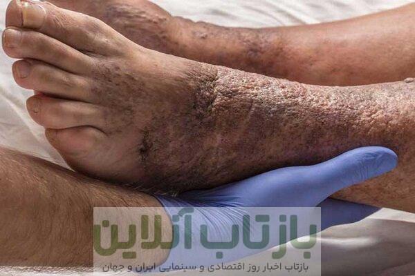 ۱۵ درصد دیابتی‌ها دچار زخم دیابتی می‌شوند