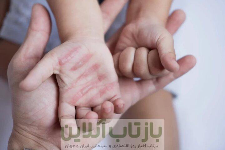 سوختگی؛ آسیب جسمی و روانی که فراتر از درمان است